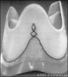 Une prothse biologique sans armature