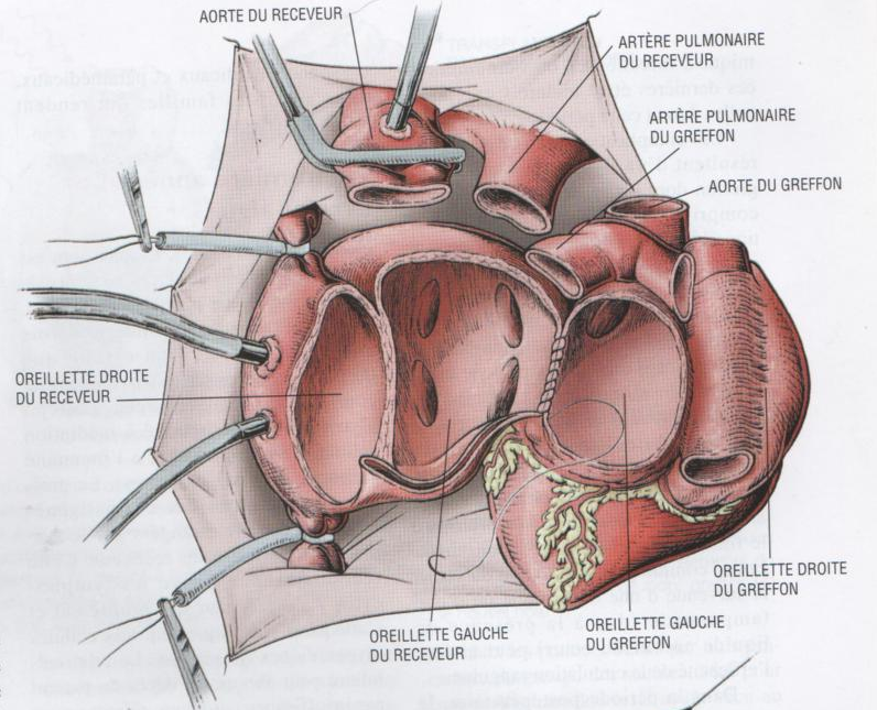 Le positionnement d'un coeur dans le cas d'une transplantation